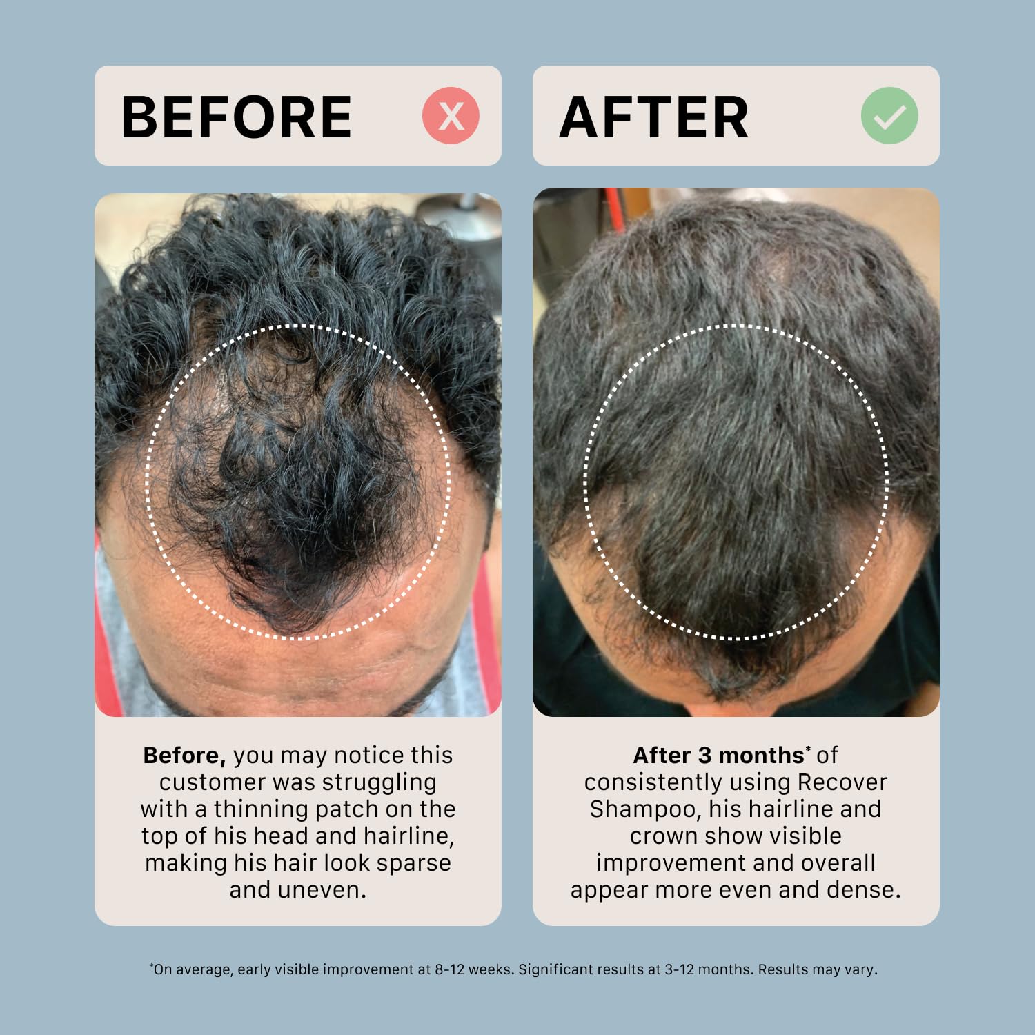 ACTIIV Recover - Tratamiento de champú engrosante para hombres | Ap...